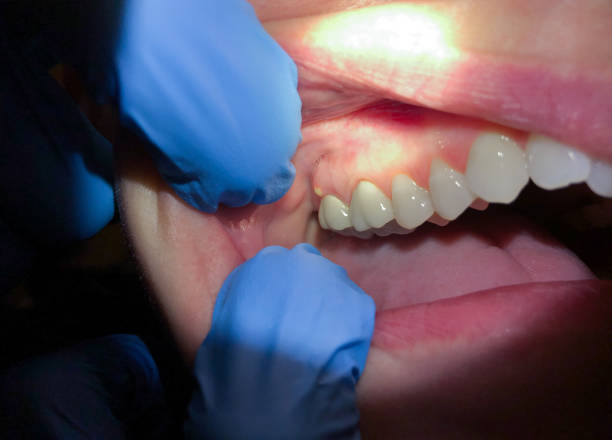 Best Emergency Care for Gum Disease in Ambler, PA